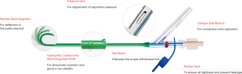 Maximize Ureteroscopic Efficiency with ClearPetra Ureteral Access Sheath(图1)