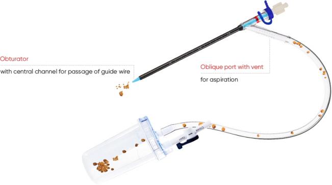 Enhancing Nephrostomy Procedures with Well Lead Medical’s ClearPetra Nephrostomy Sheath